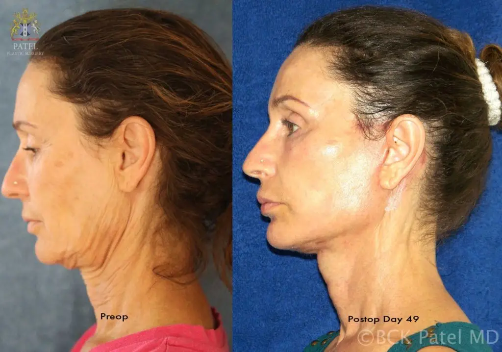 Facelift and necklift results in a female