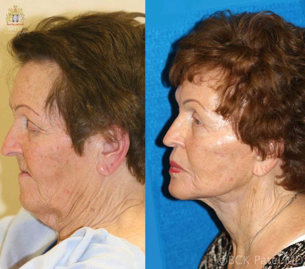 Faclift-and-necklift-in-a-female