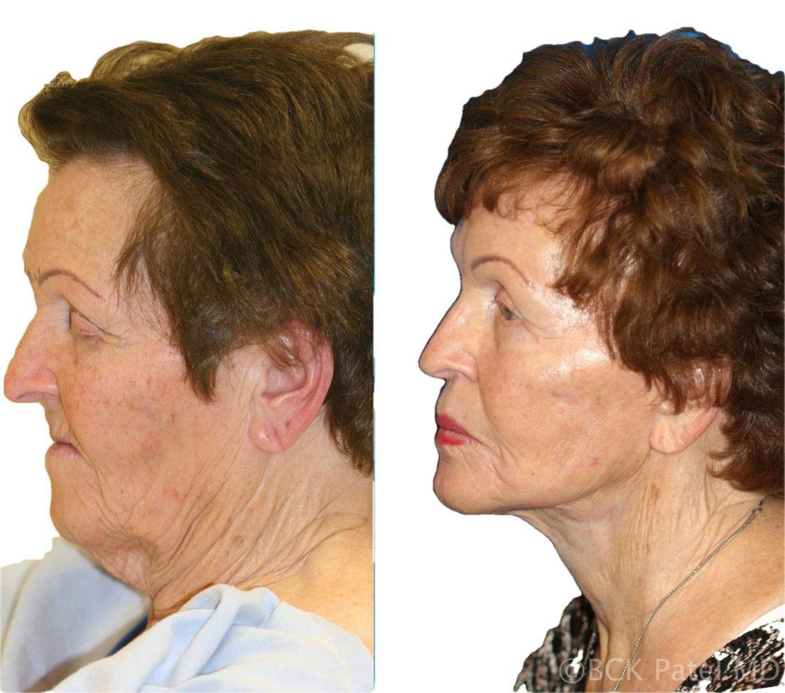 Facelift and necklift in a female showing the amazing improvement of the neck and the jowls