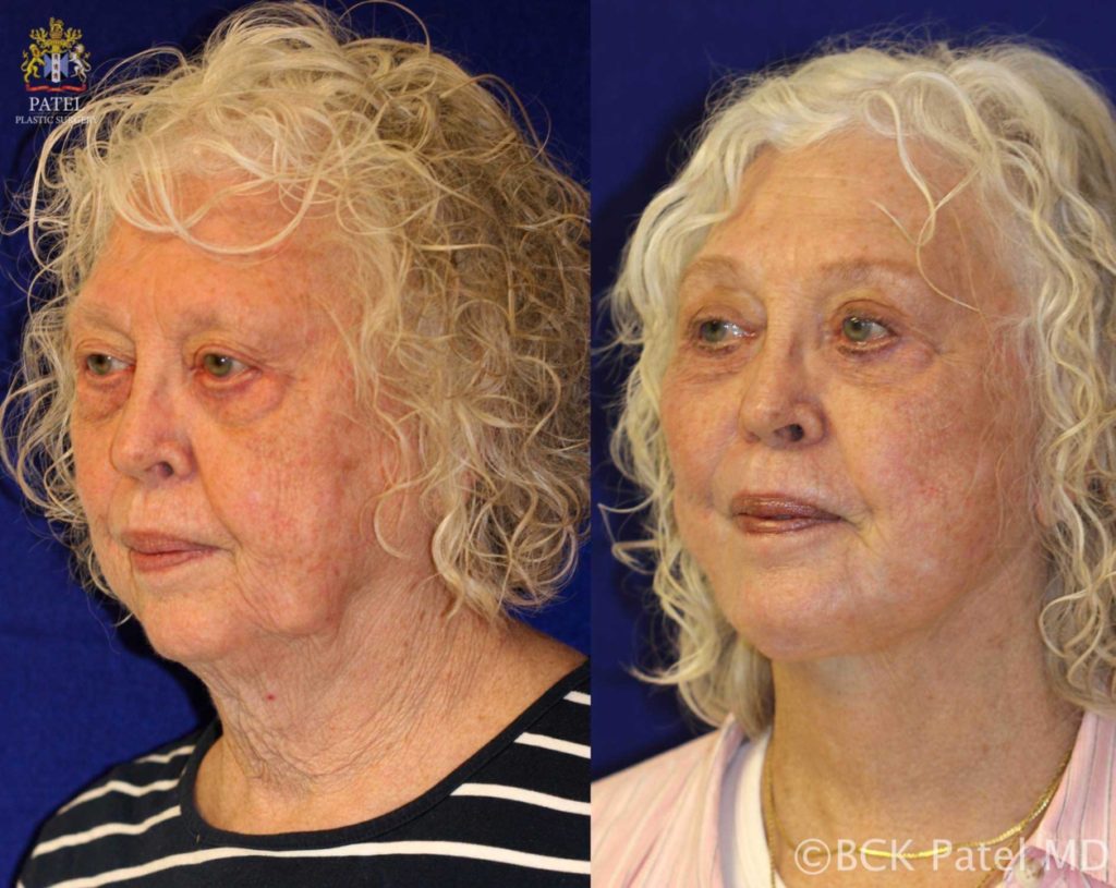 Facelift and necklift giving a beautiful result; Surgery by Dr. BCK Patel MD, FRCS, Salt Lake City, Patel Plastic Surgery