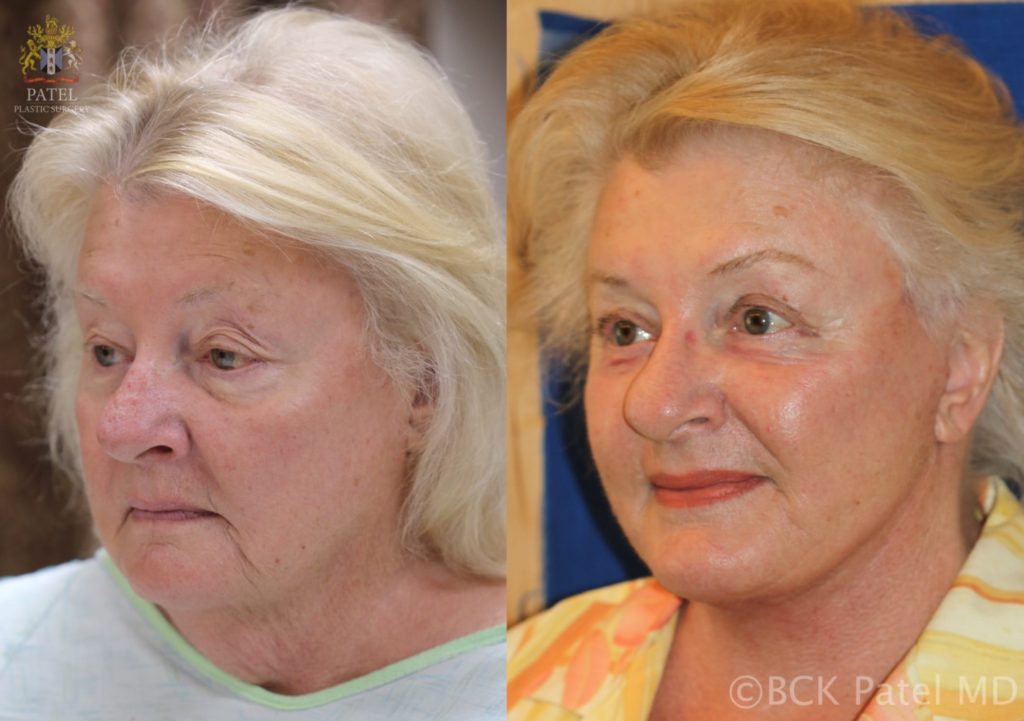 Facelift and necklift giving a beautiful result; Surgery by Dr. BCK Patel MD, FRCS, Salt Lake City, Patel Plastic Surgery