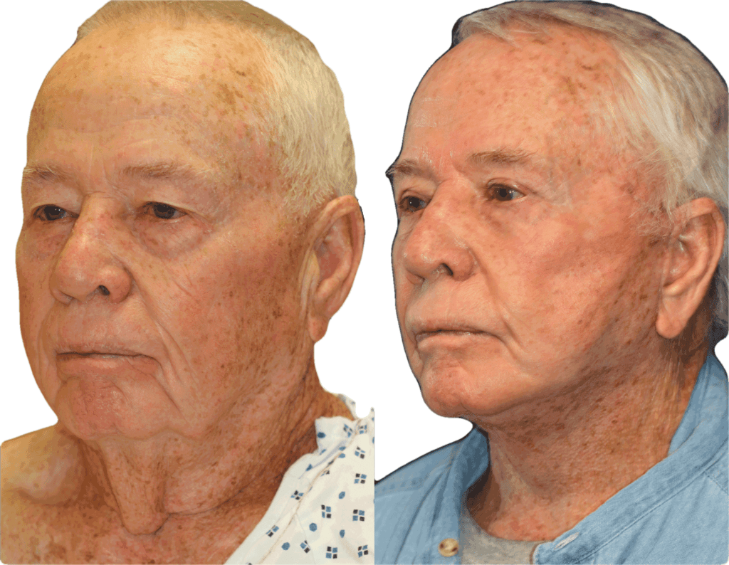 Facelift in a man by Dr. BCK Patel