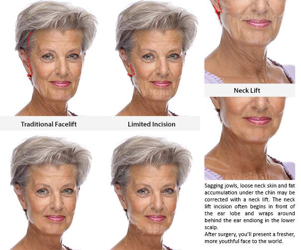 Aging causing sagging jowls, loose neck and aging chin