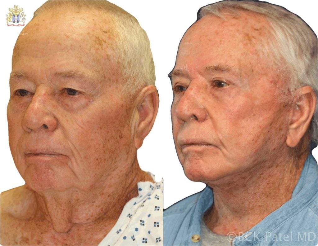 Facelift in a male by Dr. BCK Patel MD, FRCS