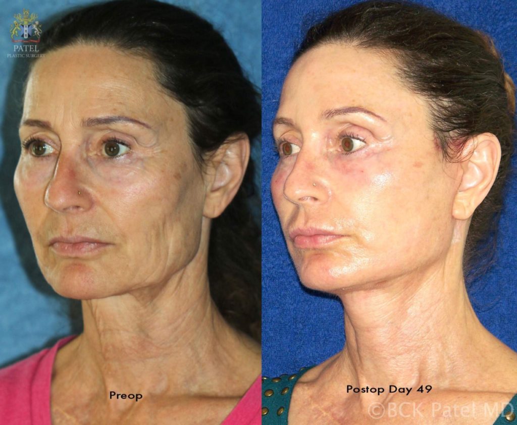 Facelift before-and-after by BCK Patel