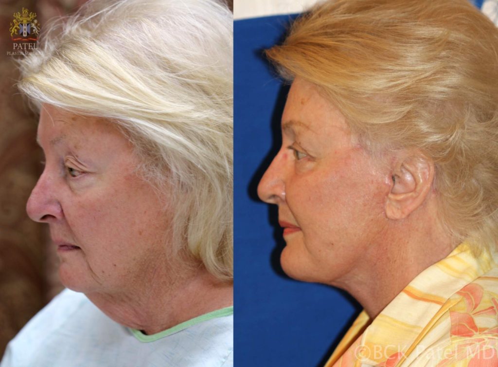 Facelift and necklift giving a beautiful result; Surgery by Dr. BCK Patel MD, FRCS, Salt Lake City, Patel Plastic Surgery