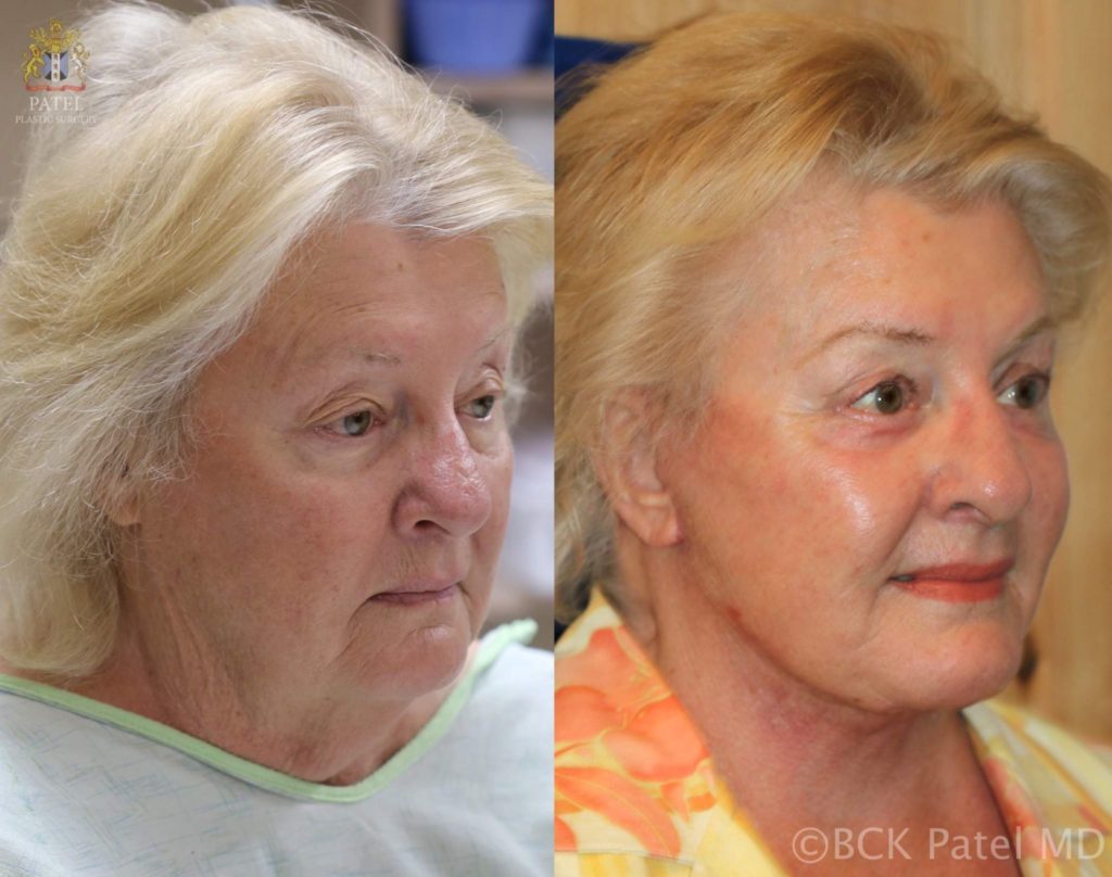 Facelift and necklift giving a beautiful result; Surgery by Dr. BCK Patel MD, FRCS, Salt Lake City, Patel Plastic Surgery