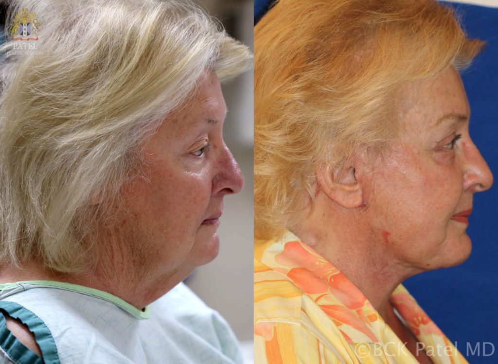 Facelift and necklift giving a beautiful result; Surgery by Dr. BCK Patel MD, FRCS, Salt Lake City, Patel Plastic Surgery