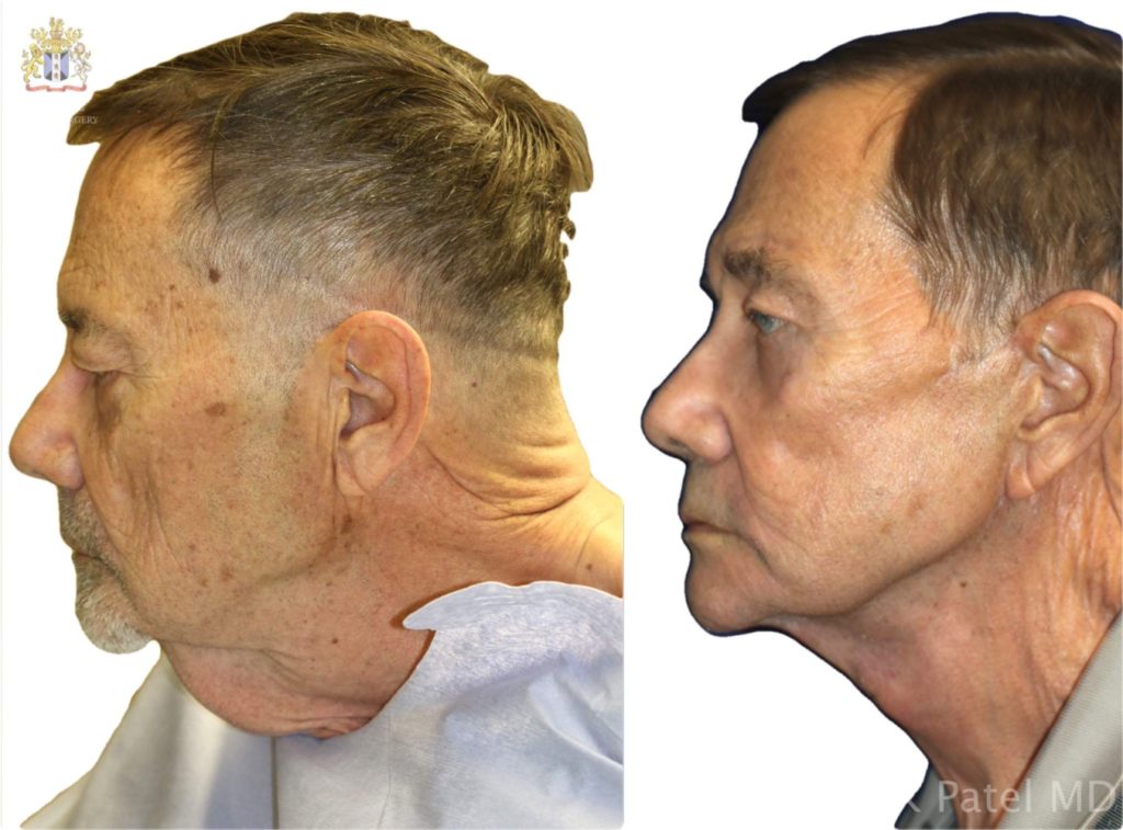 Facelift and necklift giving a beautiful result; Surgery by Dr. BCK Patel MD, FRCS, Salt Lake City, Patel Plastic Surgery